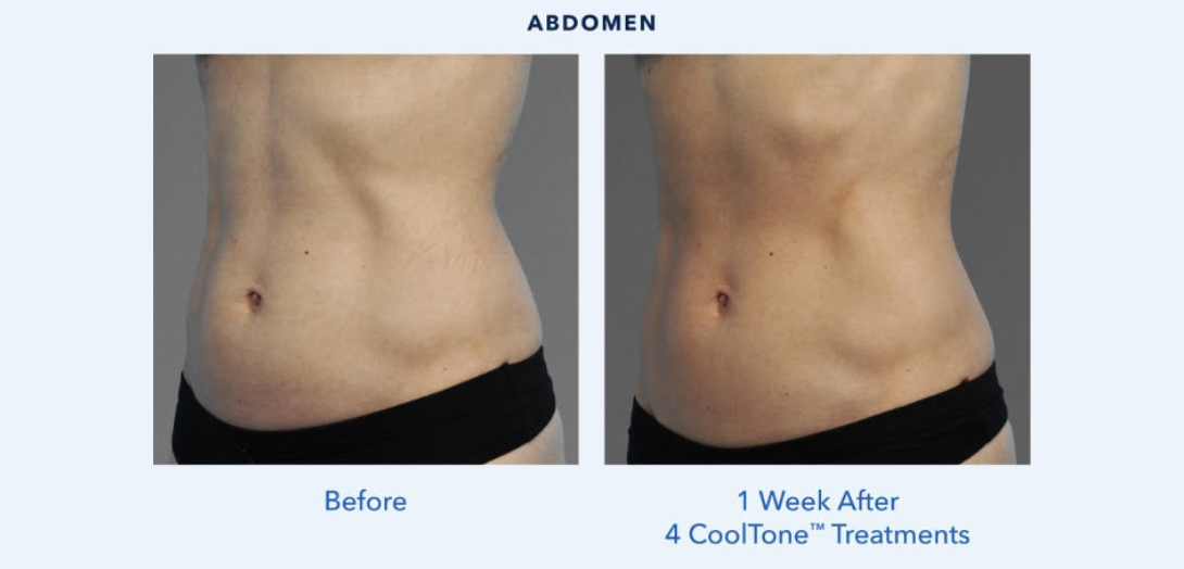 Cooltone by Coolsculpting